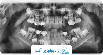 رادیوگرافی داخل و خارج دهانی
