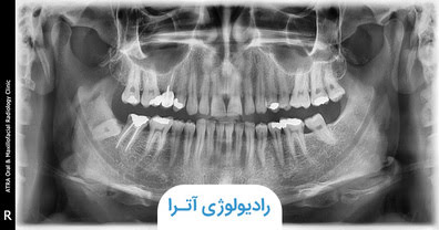 هزینه و کاربرد عکس پانورکس (OPG)