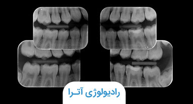 رادیوگرافی بایت وینگ یا بین دندانی چیست؟+ کاربرد آن