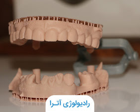 کاربرد رزین کست (کست رزینی) در دندانپزشکی | رادیولوژی آترا شیراز