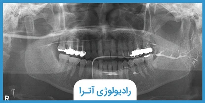 سیالوگرافی چیست؟ کاربردها، مراحل انجام و نوبت‌گیری در شیراز